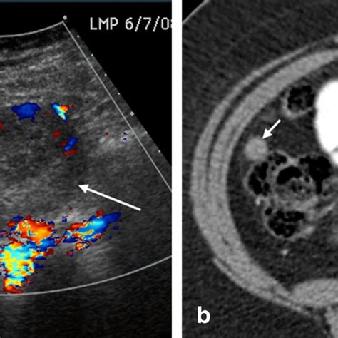 A 65 Year Old Woman With Ovarian Fibroma Ultrasound Image Of The Download Scientific Diagram