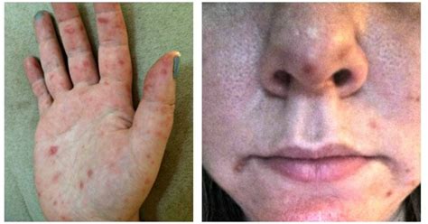 Hand Foot And Mouth Disease Adults Face