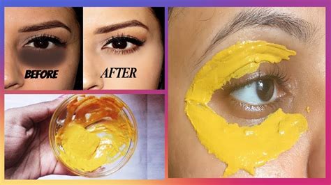 Removed Dark Circles In 5 Days With Turmeric Aloevera Eye Gel Remove