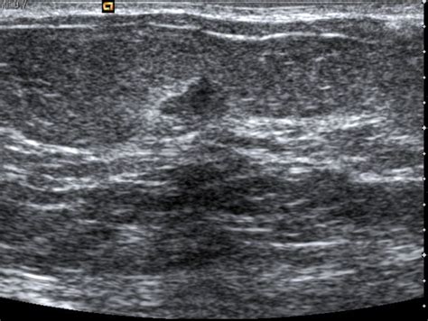 Ultrasound Guided Biopsy Of Breast