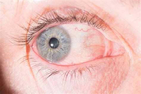 Episcleritis En El Examen Ocular 2022