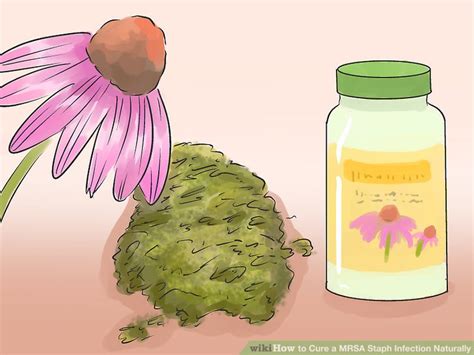 How To Cure A Mrsa Staph Infection Naturally 5 Steps