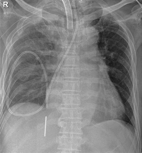 A Chest Radiograph Showing Feeding Tube Malposition Through The
