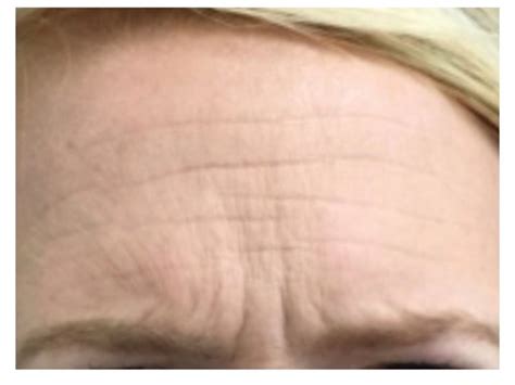 How To Get Rid Of Lines On Forehead Treatment Not Botox