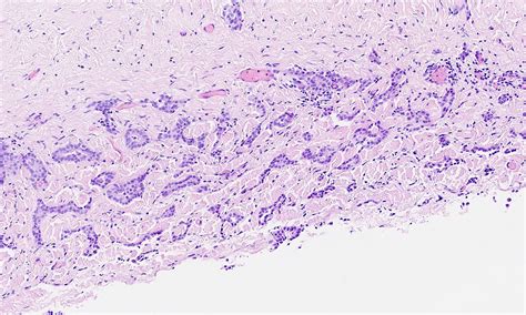 We did not find results for: Pathology Outlines - Mesothelioma - epithelioid
