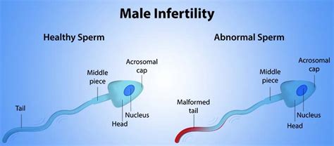 Male Infertility Ivf Center In Pune Best Clinic Infertility