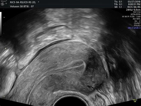 Fertility Scan Private One On One Pregnancy And Fertility Ultrasound