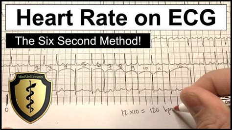 Ecg Heart Rate Calculation The Six Second Method Youtube
