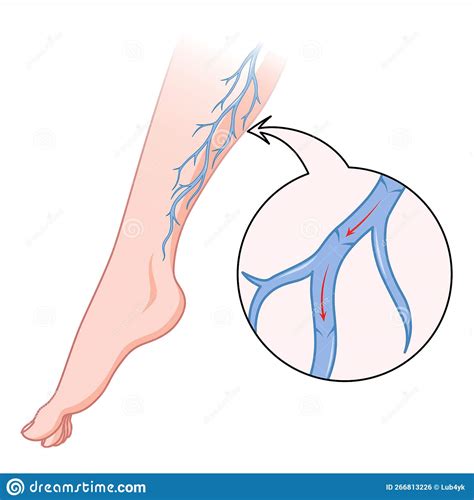 Varicose Veins Blue Blood Vessel Visible Through The Skin Abnormally