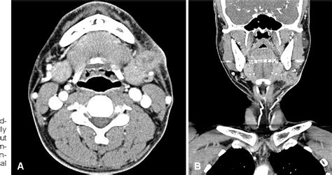 Figure 2 From A Case Of Langerhans Cell Sarcoma Presenting As