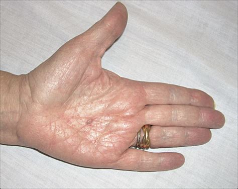 Palmar Basal Cell Carcinoma In A Patient With Gorlin Goltz Syndrome