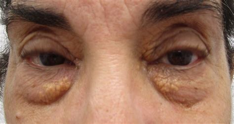 Co2 Laser Xanthelasma Removal Before And After Photos • Dr Cameron Rokhsar