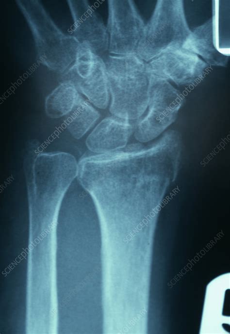 Broken Wrist X Ray Stock Image M3301081 Science Photo Library