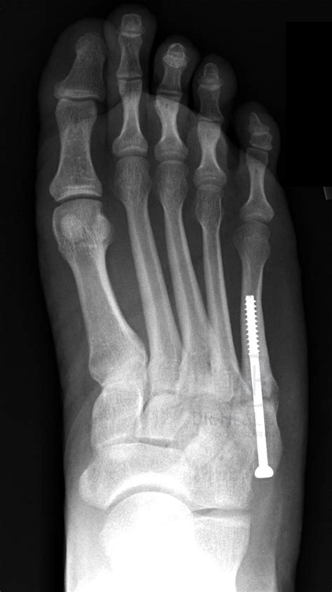 4 Types Of Fifth Metatarsal Fracture