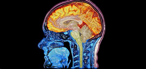 Study Finds Brain Marker Of Poor Memory In Schizophrenia Patients