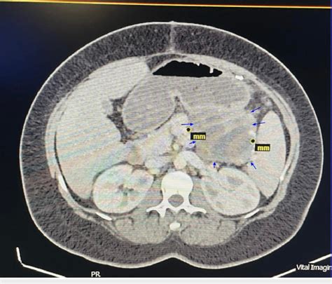 Non Contrast Ct Scan Of The Abdomen Three Months Postsurgery