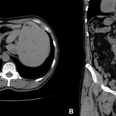 A B Ct Scan Showed Situs Inversus Totalis And No Metastasis Lesion