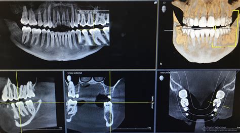 3d X Rays Changing Dentistry — Bloomington Dental