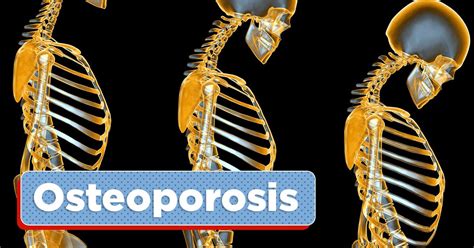 Osteoporosis Sintomas At Sanhi Medikoph