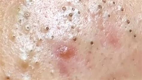 Best Pimples Popping Blackheads Youtube