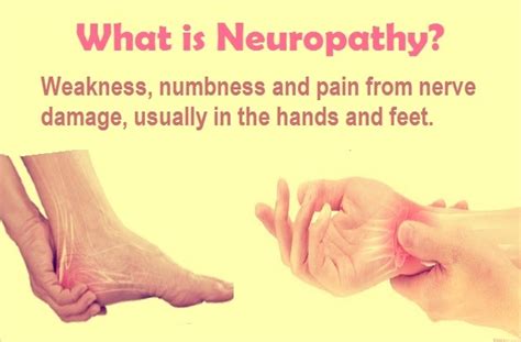 What Is Neuropathy Types Symptoms And Causes Of Neuropathy