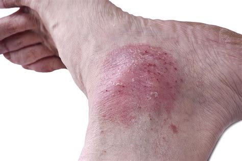 What Type Of Foot Rash Do I Have How To Know The Difference