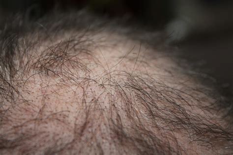 Alopecia, also commonly known as hair loss, can sometimes occur as a result of taking some medications. Can psoriasis cause hair loss? - Wound Care Society