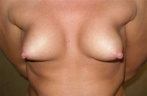 Asymmetrical And Ugly Tits Pics Xhamster