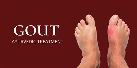 Ayurvedic Gout Treatment Total Ayurveda Ayurvedic Clinic