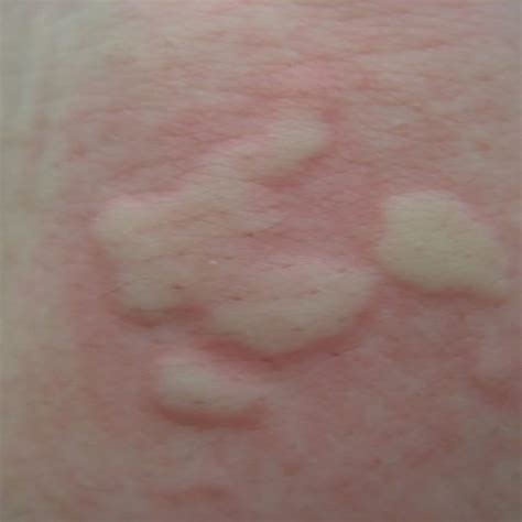 Skin Allergy Allergy Medik