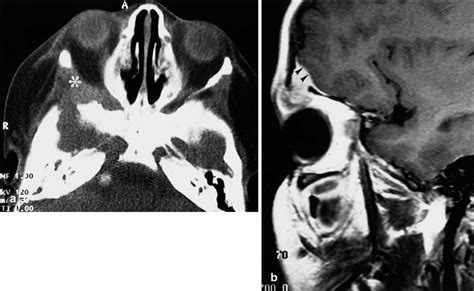 A B Eosinophilic Granuloma Histiocytosis X A Axial Ct Scan Bone