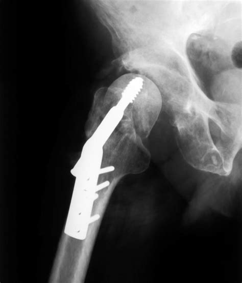 What Are The Pros And Cons Of A Ceramic Hip Replacement