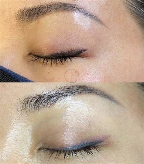 Remove Permanent Eyeliner Benefits Side Effects And Cost