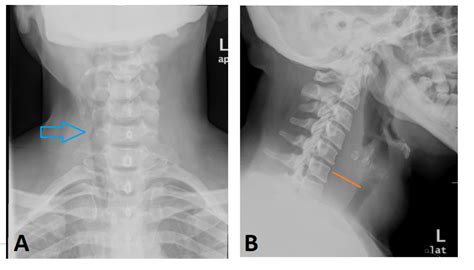 Cureus A Rare And Challenging Case Of Neck Infection Thyroid Abscess