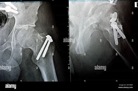 Plain X Ray On Left Hip Joined With A Fracture Of The Greater