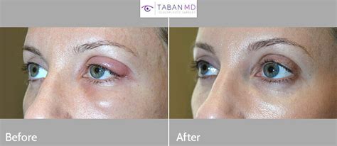 Eyelid Chalazion Surgery Before And After Gallery Taban Md