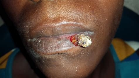 Squamous Cell Carcinoma Of The Lip Rahi Medical Outreach