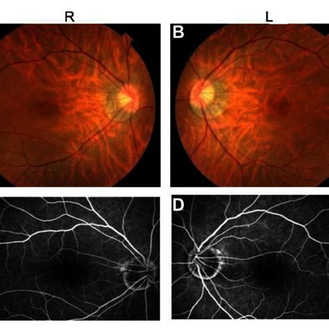 Photographs Of The Fundus A And B And Fluorescein Angiography C And