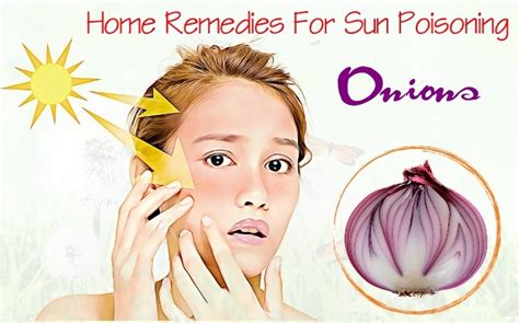Top 25 Natural Home Remedies For Sun Poisoning Rash