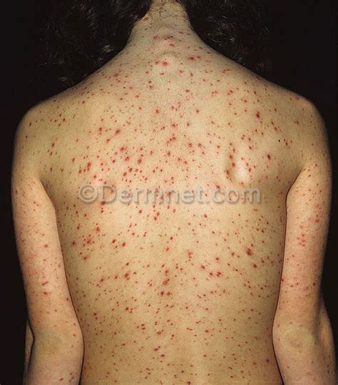 Varicella Photo - Skin Disease Pictures