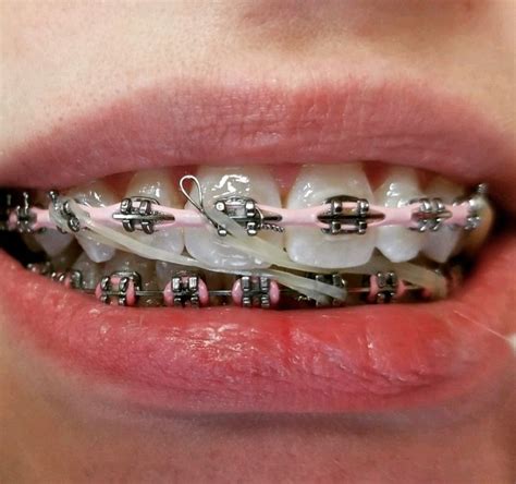 pin by elpotrillo31 on braces dental braces braces colors pink braces