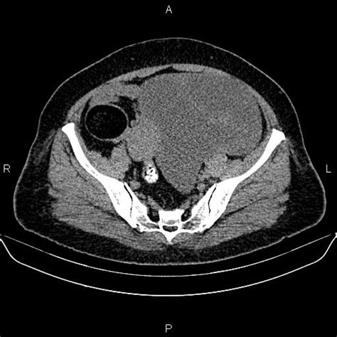 Ovarian Serous Cystadenocarcinoma Image