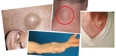 How To Get Rid Of Skin Lumps Lipomas Naturally Health And Healthy Life