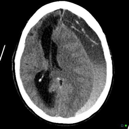 Acute On Chronic Subdural Hematoma Radiology Case Radiopaedia Org