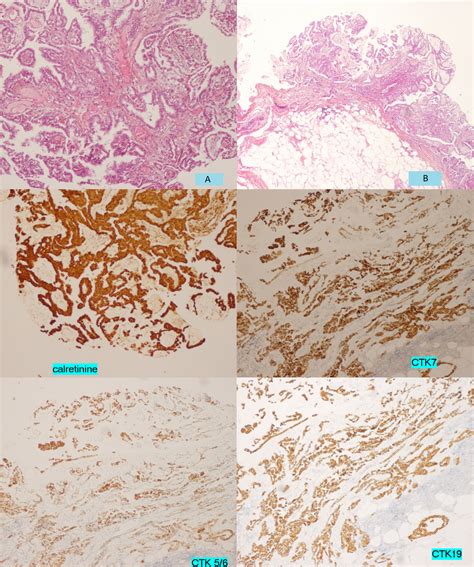 Cureus A Case Of Well Differentiated Papillary Mesothelioma Of The