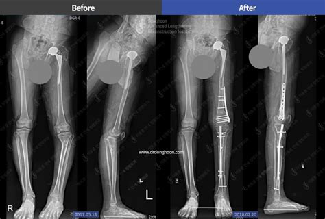 Leg Shortening Surgery Koreatown