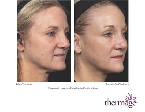 Thermage Before After Smac13 Small Medical Spa In San Diego