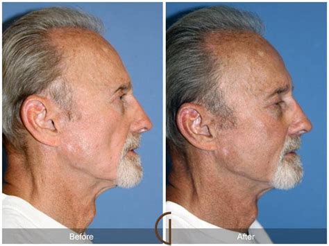 Facial Fat Grafting Before And After Photos Patient 28 Dr Kevin Sadati