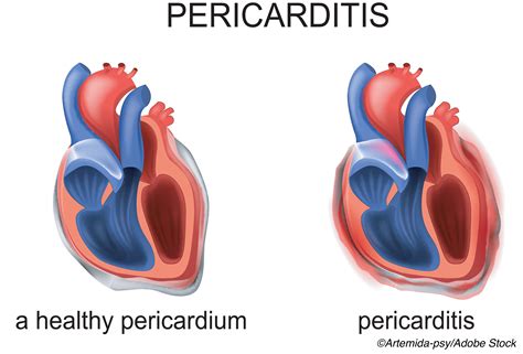 Pericarditis Tied To Mortality Morbidity Risks Physicians Weekly