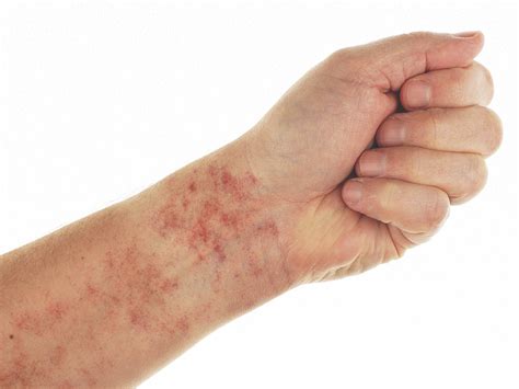 Bleeding Into The Skin Causes Diagnosis And Treatments